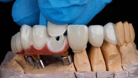 Vodič kroz protetske radove: Što možete očekivati u Dentico